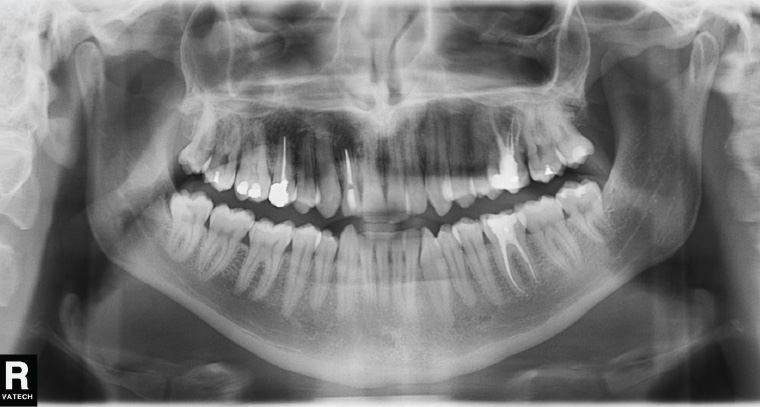 opg scan harley street dental scan opg x ray