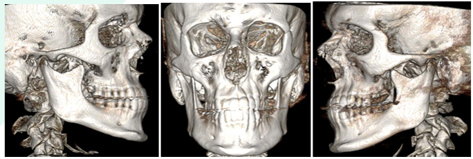3Beam Face XRay