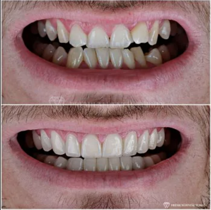 Turkey teeth smile makeover with dental implants abroad