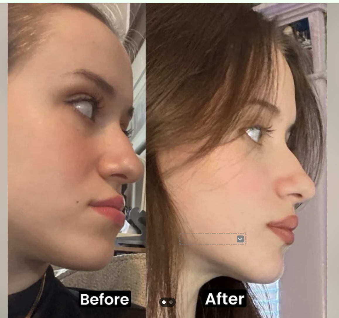 genioplasty before after CBCT