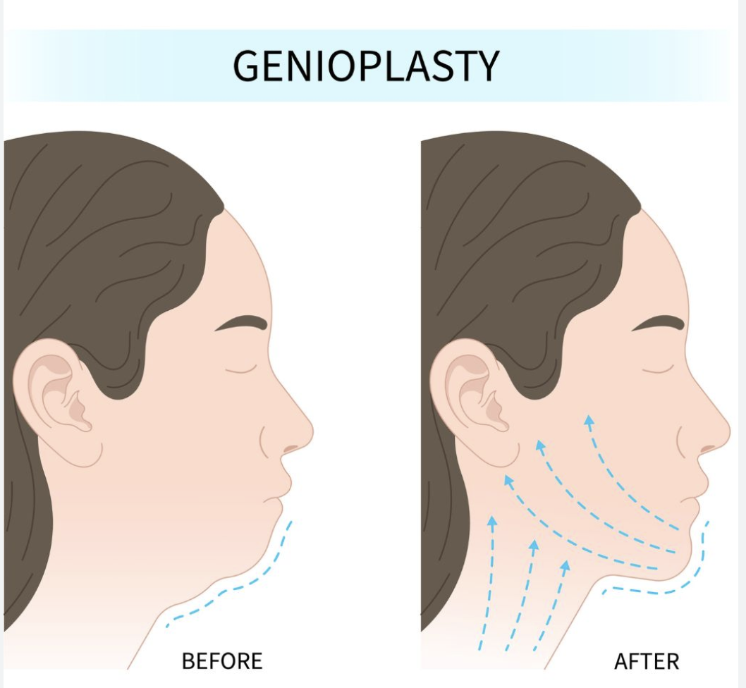 genioplasty cbct london