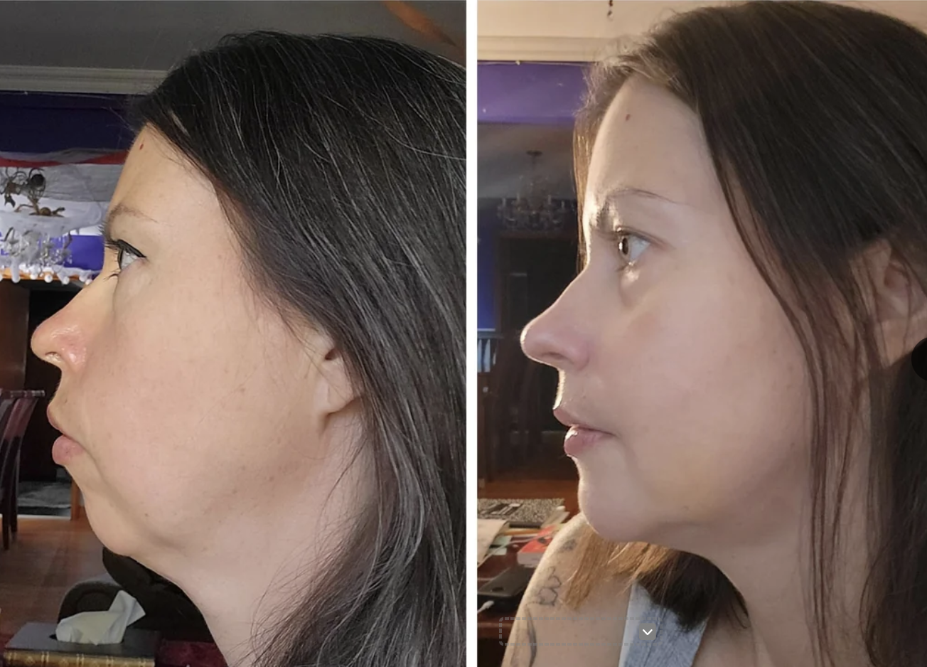 ct scan cbct genioplasty london