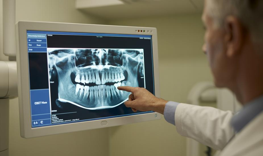 CBCT MRONJ jaw imaging showing bone pathology on radiology workstation