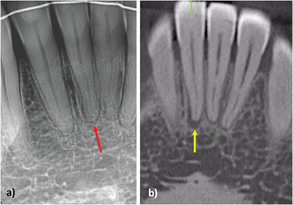 endodontic cbct morita root canal